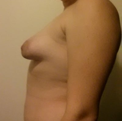 Transsexual breast developement pictures