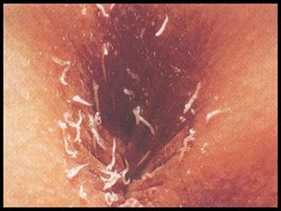 Opaline recommend best of human Anal parasite worm