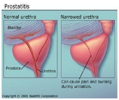 Discolored sperm prostatitis