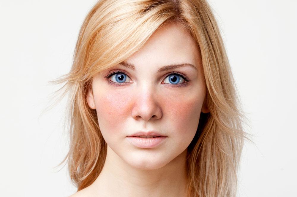 Laser treatment for facial redness caused by rosecea
