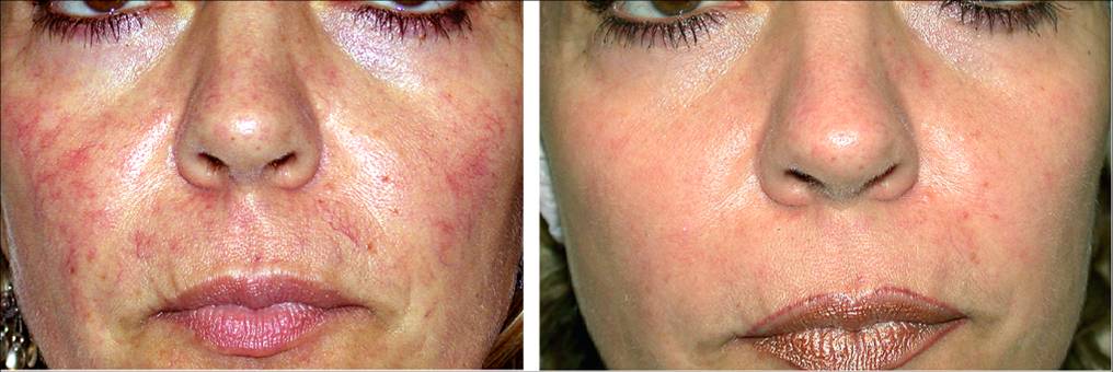 best of For by rosecea treatment Laser redness caused facial