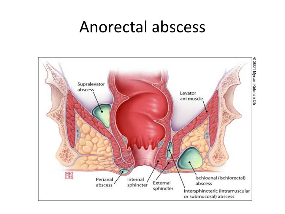 Anal abscess surgury