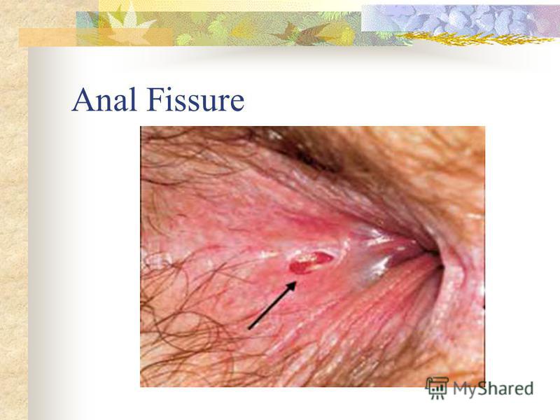 Nitropaste for anal fissure Anal