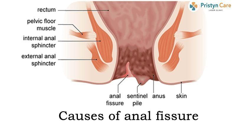 best of And relaxation fissures Anal