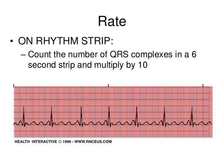 Sir reccomend Heart rhythm strip