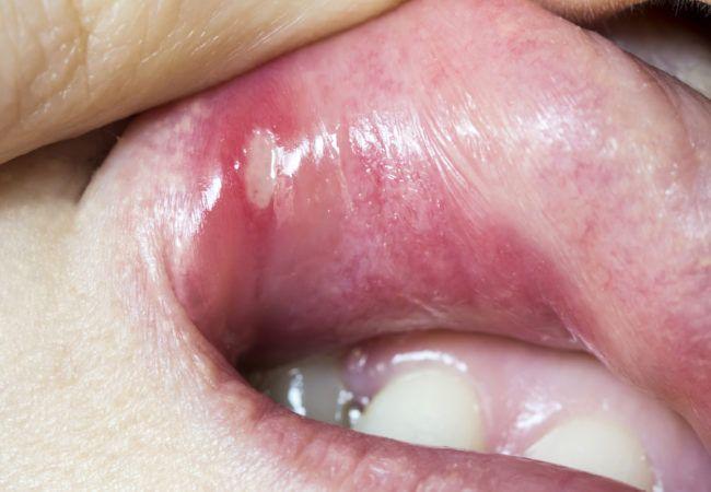 Jasper reccomend Mouth sores caused by oral sex
