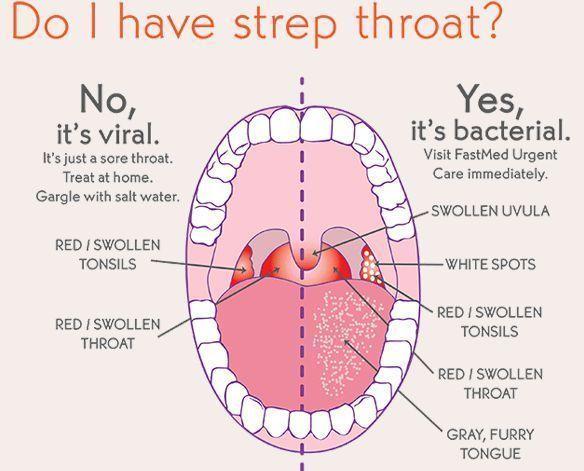 Guppy reccomend Swellen throat in adults